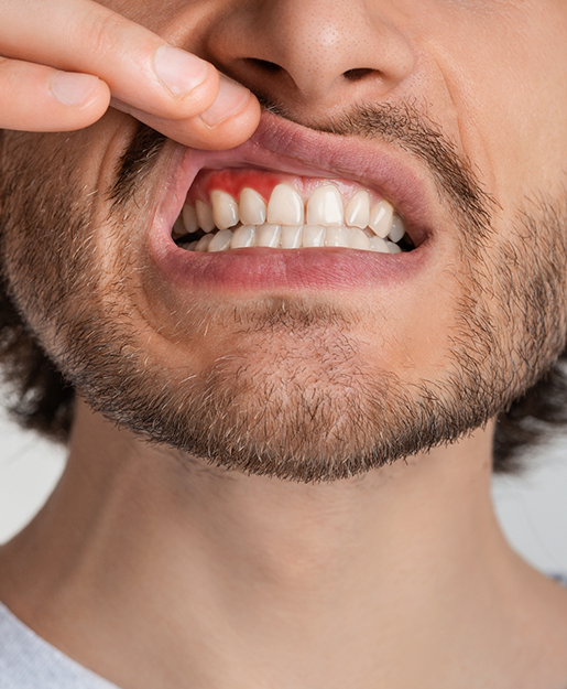 Man pointing to a red spot in his gums