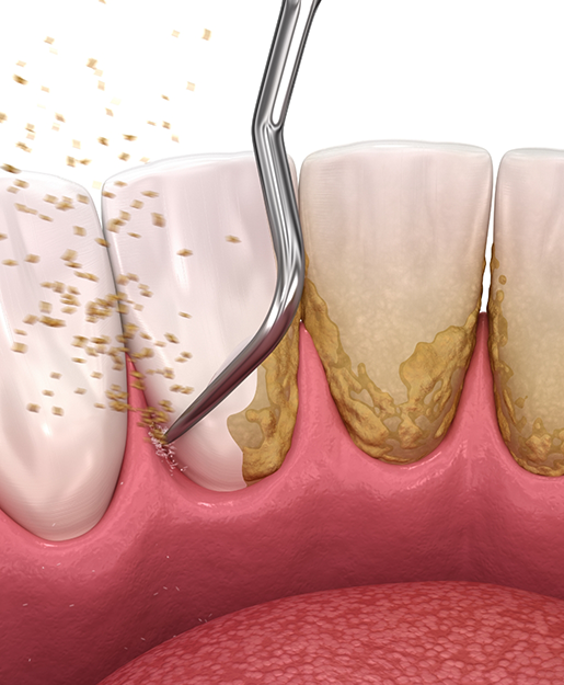 Illustration of a dental scaler removing tartar buildup from the teeth