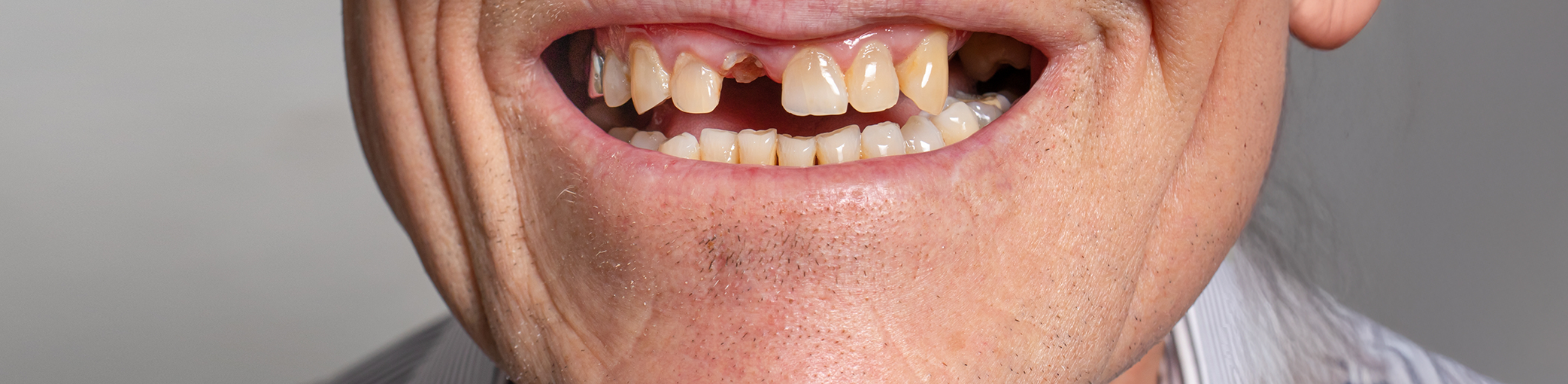 Close up of a smile with a few missing teeth