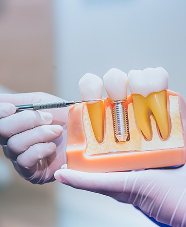 a dentist demonstrating how dental implants work