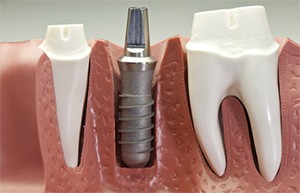 dental implant post