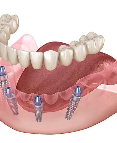 Illustration of all-on-4 dentures in lower arch with white background