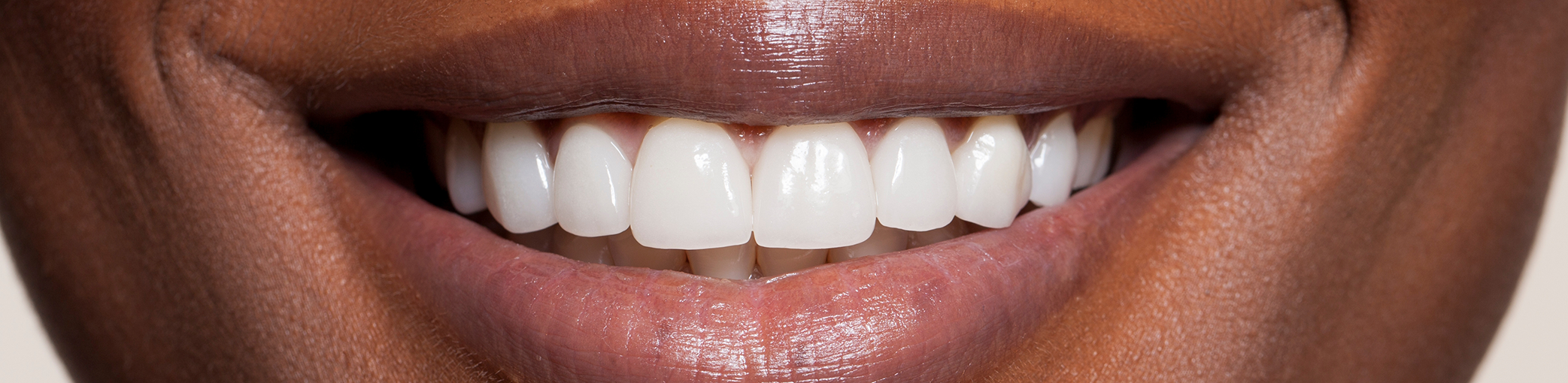 Close up of a flawless smile after teeth whitening in Bullard
