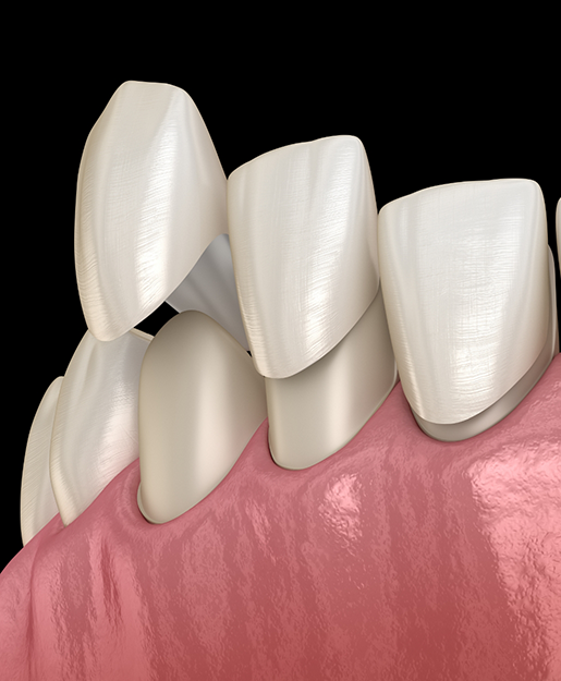 Illustration of veneers being placed over the fronts of teeth